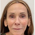 XERF Before & After Patient #4052