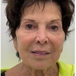 XERF Before & After Patient #3998