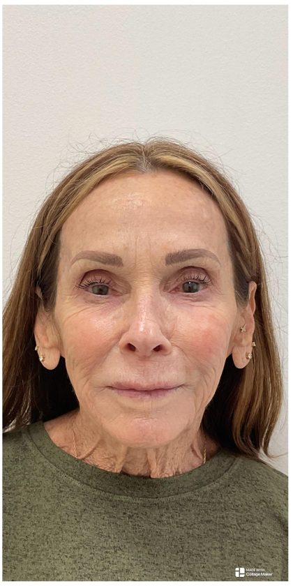 XERF Before & After Patient #4052