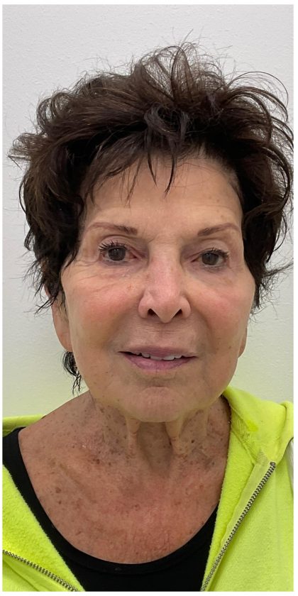 XERF Before & After Patient #3998