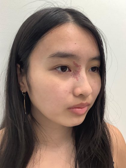 Birthmark Removal Before & After Patient #4031