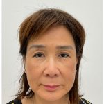Facial Fillers Before & After Patient #3999