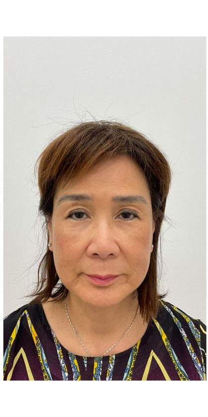 Facial Fillers Before & After Patient #3999
