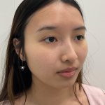 Birthmark Removal Before & After Patient #4031