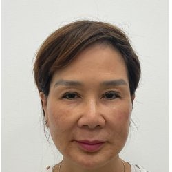 Facial Fillers Before & After Patient #3999