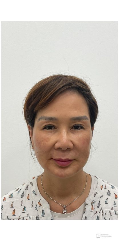Facial Fillers Before & After Patient #3999