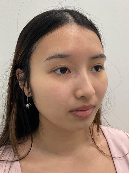Birthmark Removal Before & After Patient #4031