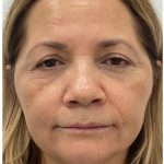 Botox Before & After Patient #4000