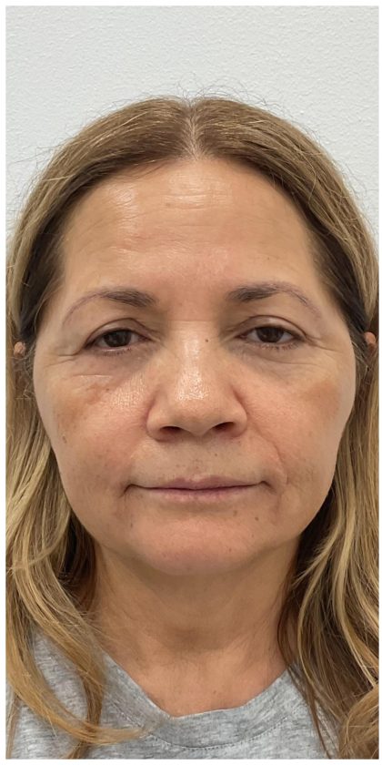 Botox Before & After Patient #4000