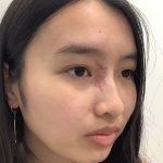 Birthmark Removal Before & After Patient #4031