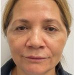 Botox Before & After Patient #4000