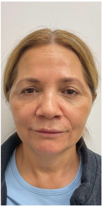 Botox Before & After Patient #4000