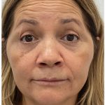 Botox Before & After Patient #4000