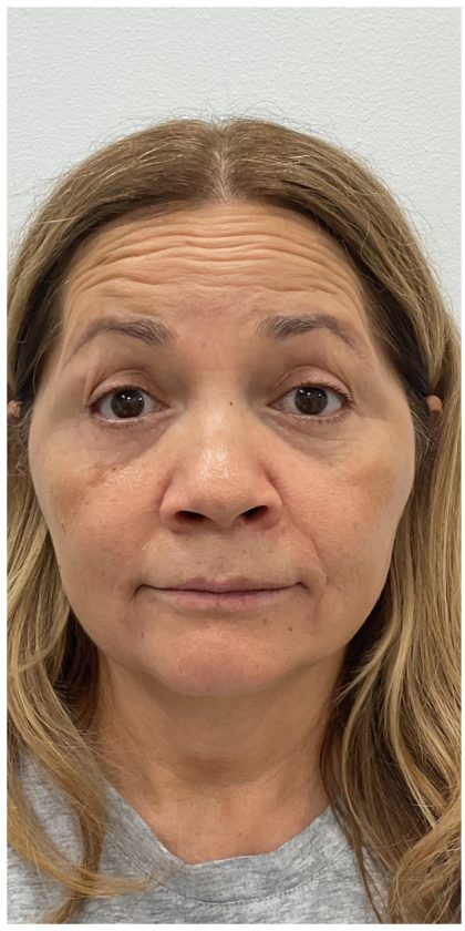 Botox Before & After Patient #4000