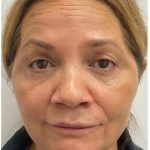 Botox Before & After Patient #4000