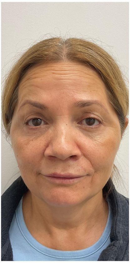 Botox Before & After Patient #4000