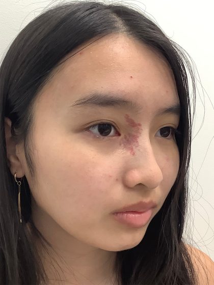Birthmark Removal Before & After Patient #4031
