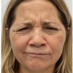 Botox Before & After Patient #4000