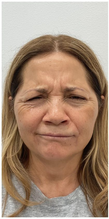 Botox Before & After Patient #4000