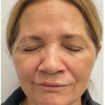 Botox Before & After Patient #4000
