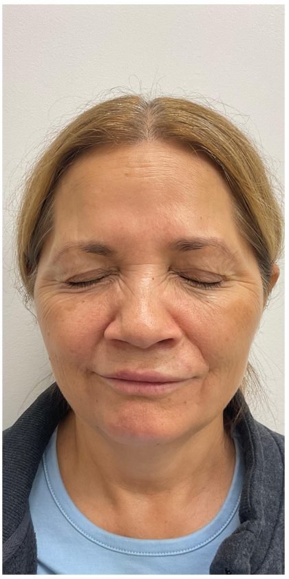 Botox Before & After Patient #4000