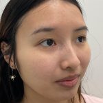 Birthmark Removal Before & After Patient #4031