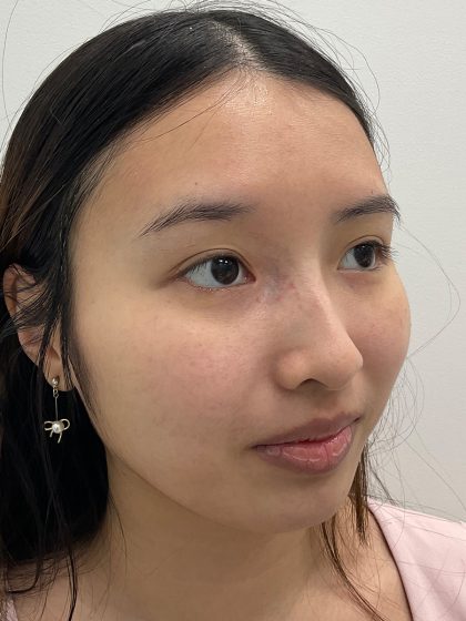 Birthmark Removal Before & After Patient #4031