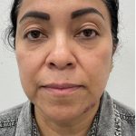 Under Eye Fillers Before & After Patient #4165