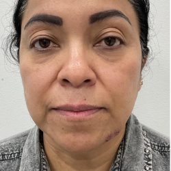 Under Eye Fillers Before & After Patient #4165