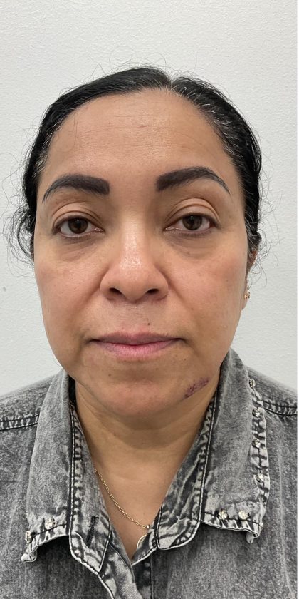 Under Eye Fillers Before & After Patient #4165