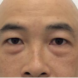 Under Eye Fillers Before & After Patient #4151