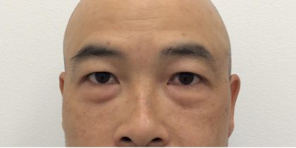 Under Eye Fillers Before & After Patient #4151