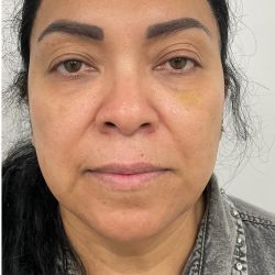 Under Eye Fillers Before & After Patient #4165