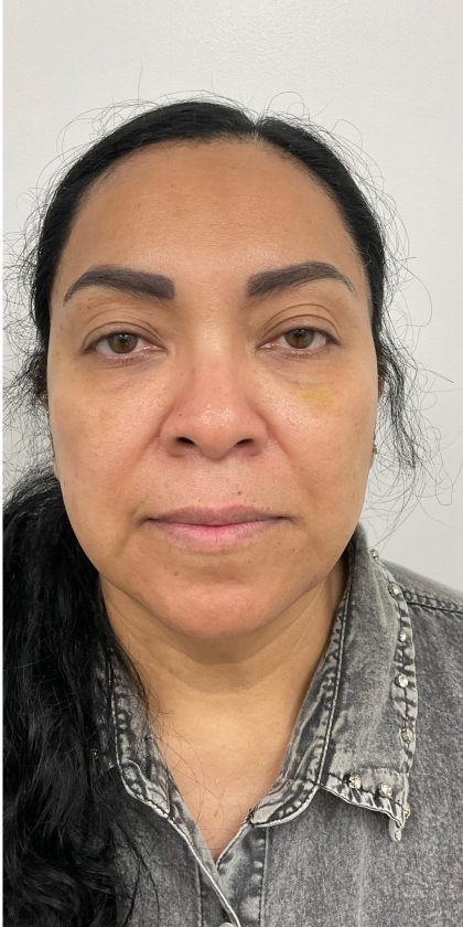 Under Eye Fillers Before & After Patient #4165
