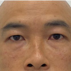 Under Eye Fillers Before & After Patient #4151