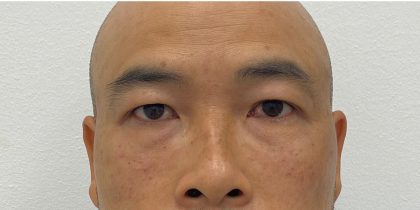 Under Eye Fillers Before & After Patient #4151