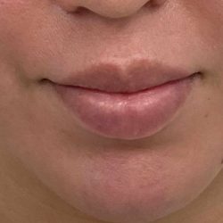 Lip Fillers Before & After Patient #4180