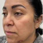 Under Eye Fillers Before & After Patient #4165