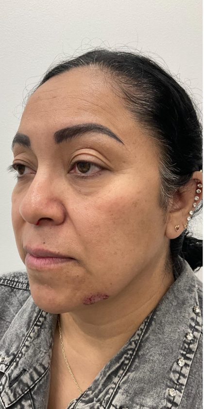 Under Eye Fillers Before & After Patient #4165