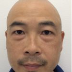 Under Eye Fillers Before & After Patient #4151