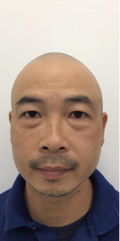 Under Eye Fillers Before & After Patient #4151