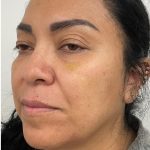 Under Eye Fillers Before & After Patient #4165