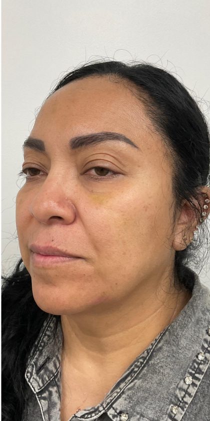 Under Eye Fillers Before & After Patient #4165