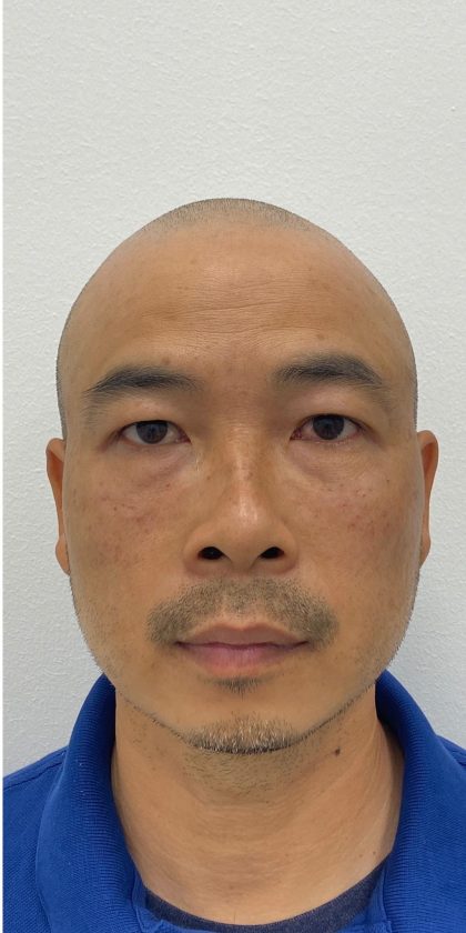 Under Eye Fillers Before & After Patient #4151