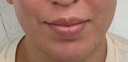 Lip Fillers Before & After Patient #4180