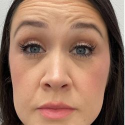 Botox Before & After Patient #4166