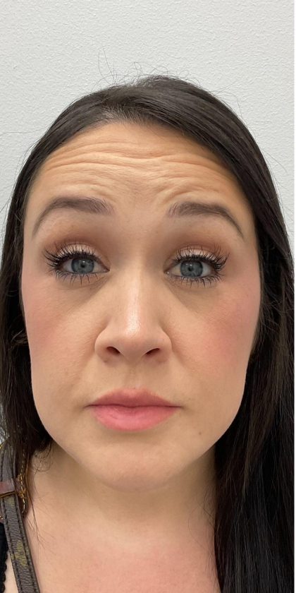 Botox Before & After Patient #4166