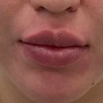 Lip Fillers Before & After Patient #4180