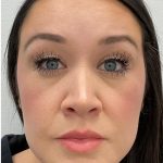 Botox Before & After Patient #4166