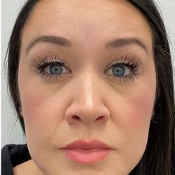 Botox Before & After Patient #4166